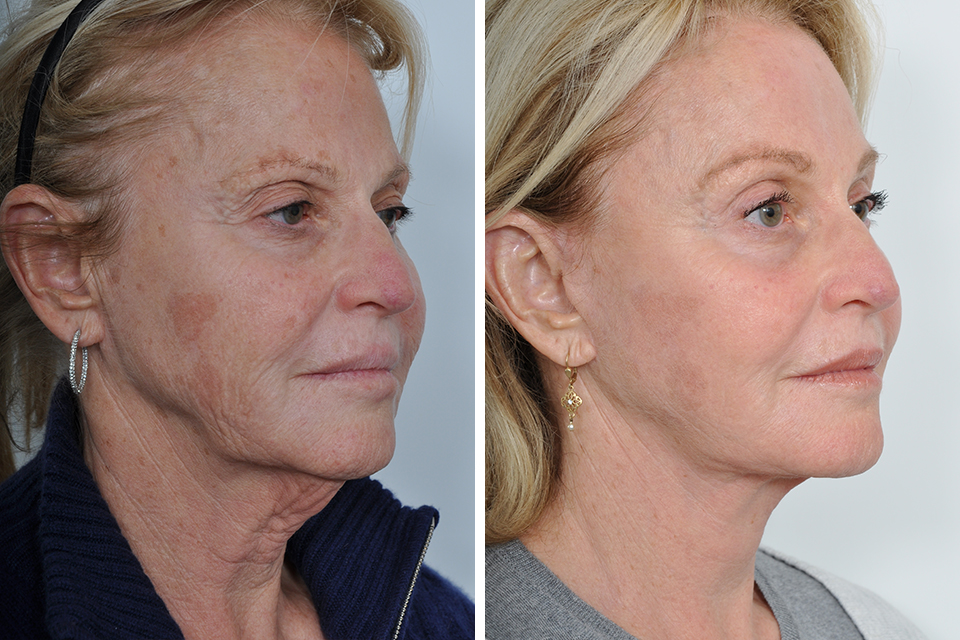 What is a laser neck lift?