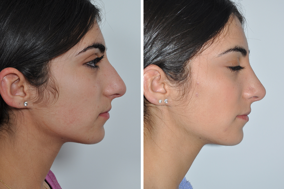 Rhinoplasty, Nose Surgery, Nose Job for Women in New York City David Rosenberg, M.D., PLLC