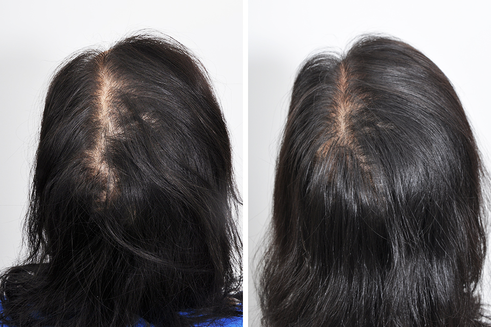 Hair Loss Treatments (Surgical) For Women - Dr. David Rosenberg
