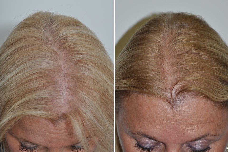 Hair Loss Treatments (Surgical) For Women - Dr. David Rosenberg