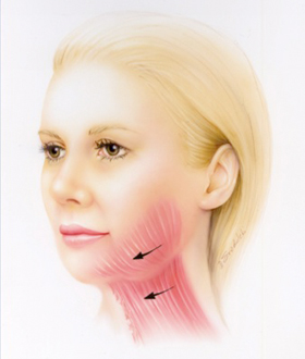 The aging face reveals descent of the muscle with attendant jowls and a loose neck.