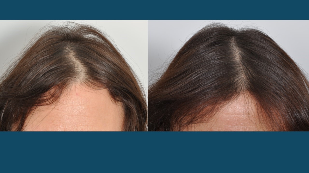 Hair Loss Treatments (Non-Surgical) For Women - Dr. David Rosenberg