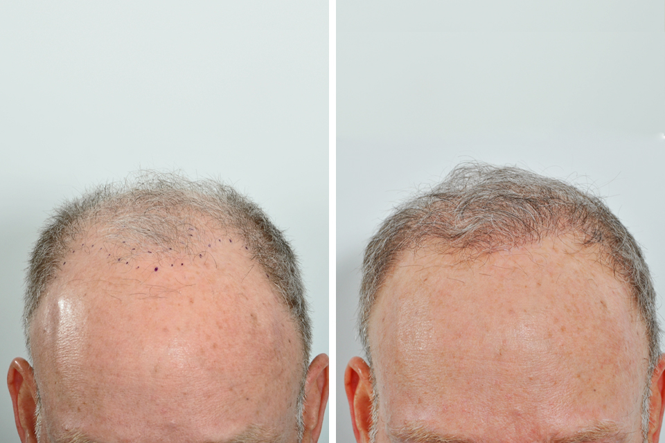Hair Restoration For Men - Dr. David Rosenberg