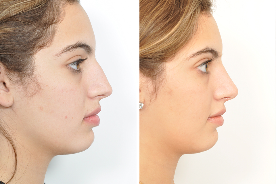 Before and after rhinoplasty at 4 weeks post op 