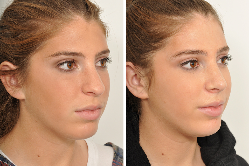 Before and after rhinoplasty at 2 weeks post op 