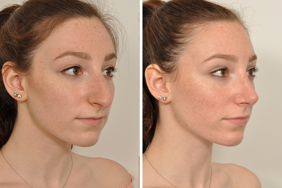 Rhinoplasty, Nose Surgery, Nose Job for Women in New York.