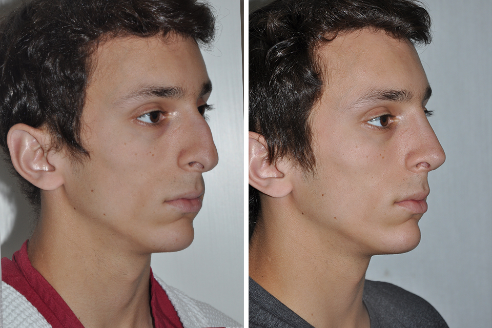 Rhinoplasty Nose Surgery Job Before Weeks David Op Dr.