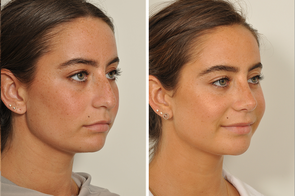 Before and after rhinoplasty at 3 months post op.
