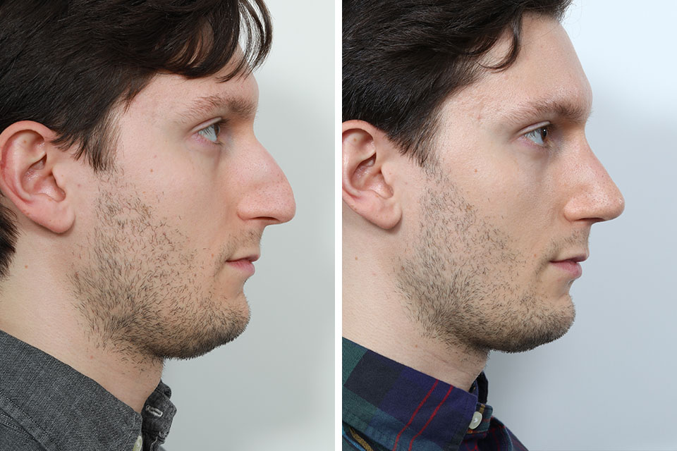 Nose jobs male before and afters