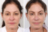 Rhinoplasty case #4092 slider thumbnail