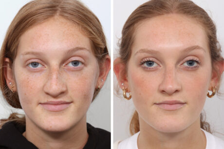 Rhinoplasty case #3963