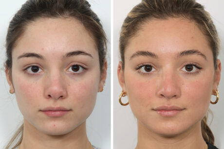 Rhinoplasty case #4041
