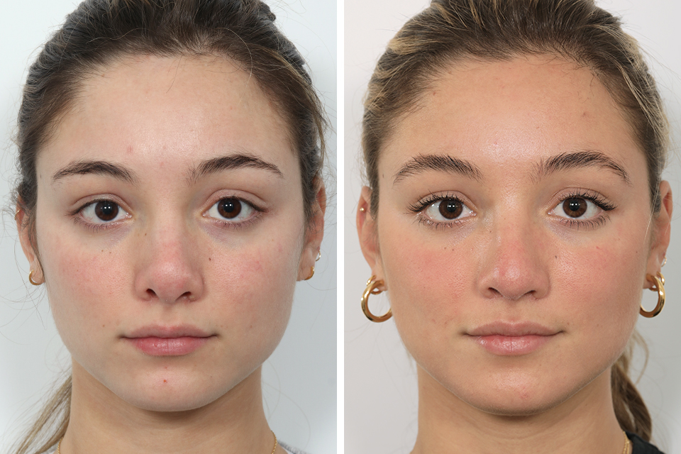 Rhinoplasty case #4041