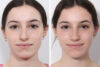 Rhinoplasty case #3950 slider thumbnail