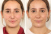 Rhinoplasty case #4112 slider thumbnail