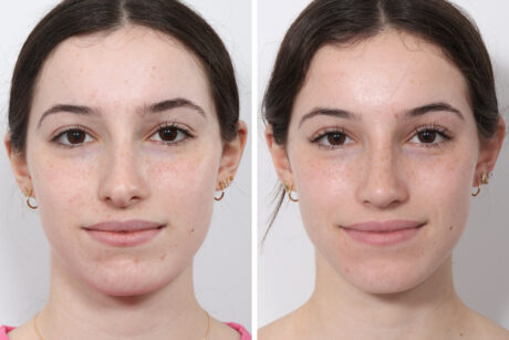 Rhinoplasty case #3950