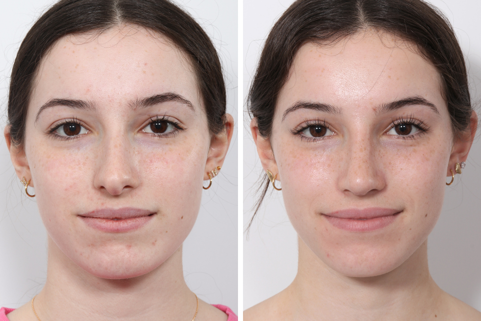 Rhinoplasty case #3950