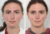 Rhinoplasty case #4146 slider thumbnail