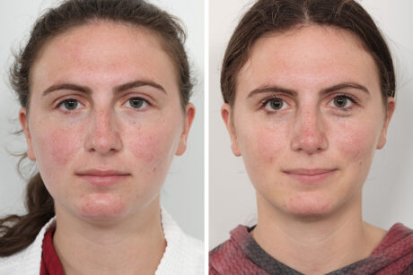 Rhinoplasty case #4146