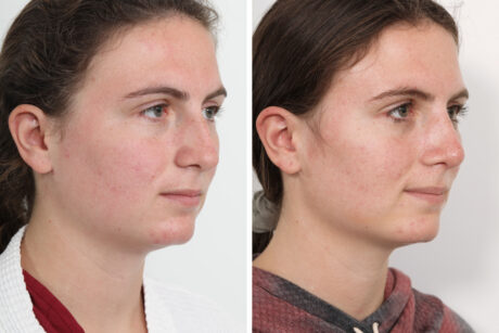 Rhinoplasty case #4146