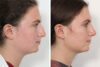 Rhinoplasty case #4146 slider thumbnail