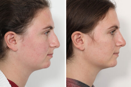 Rhinoplasty case #4146