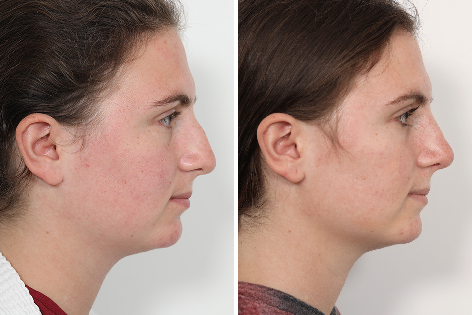 Rhinoplasty case #4146