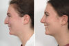 Rhinoplasty case #4146 slider thumbnail