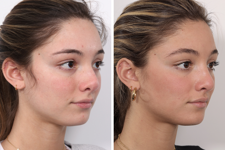 Rhinoplasty case #4041