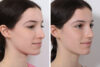 Rhinoplasty case #3950 slider thumbnail