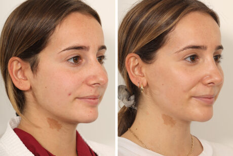 Rhinoplasty case #4112