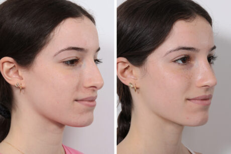 Rhinoplasty case #3950