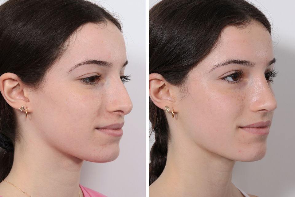 Rhinoplasty case #3950