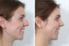 Rhinoplasty case #4141 slider thumbnail