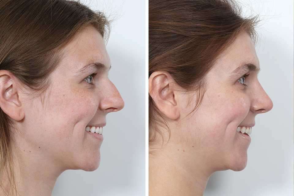 Rhinoplasty case #4141