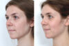 Rhinoplasty case #4141 slider thumbnail