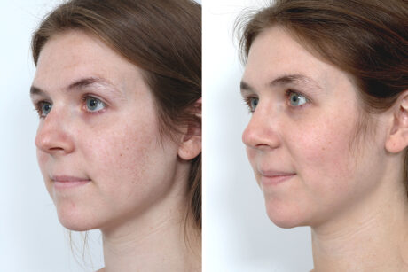 Rhinoplasty case #4141
