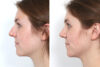 Rhinoplasty case #4141 slider thumbnail
