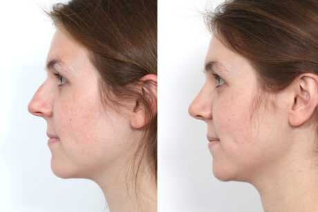 Rhinoplasty case #4141