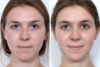 Rhinoplasty case #4141 slider thumbnail