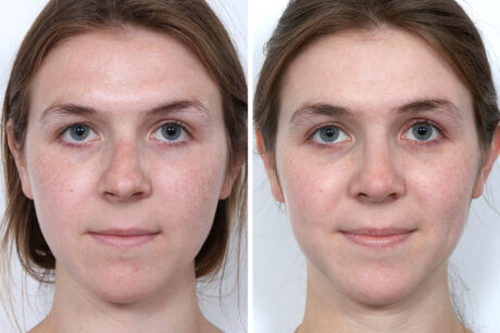 Rhinoplasty case #4141