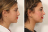 Rhinoplasty case #4102 slider thumbnail