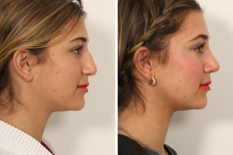 Rhinoplasty case #4102