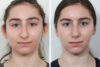 Rhinoplasty case #4118 slider thumbnail