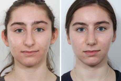 Rhinoplasty case #4118