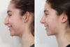 Rhinoplasty case #4118 slider thumbnail