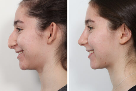 Rhinoplasty case #4118