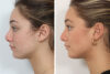 Rhinoplasty case #4041 slider thumbnail