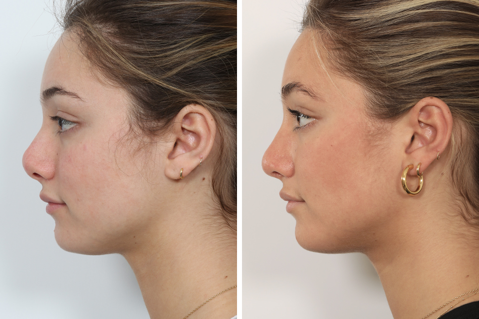 Rhinoplasty case #4041