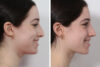 Rhinoplasty case #3950 slider thumbnail
